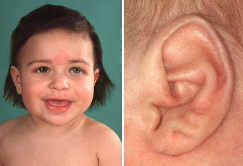 Beckwith-Wiedemann syndrome Beckwith-Wiedemann_syndrome (2).jpg
